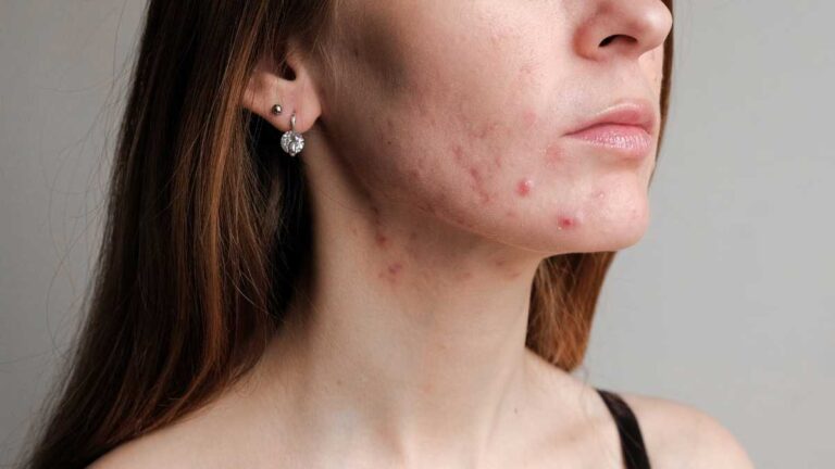 Quais as tetraciclinas usadas pra acne